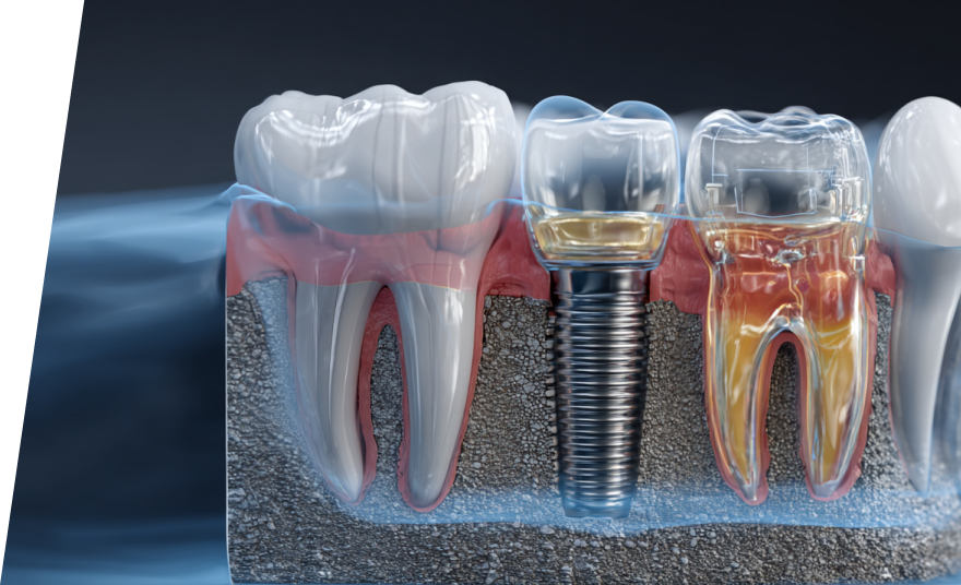 インプラントのリスクと安全管理
