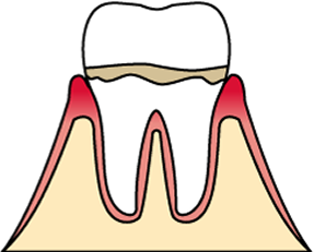 軽度歯周炎