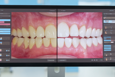 口腔内写真の撮影